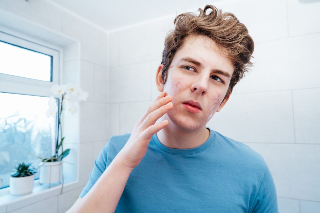 Teenage Behandling Hud